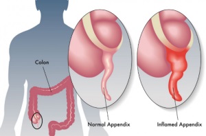 diagnosi appendicite