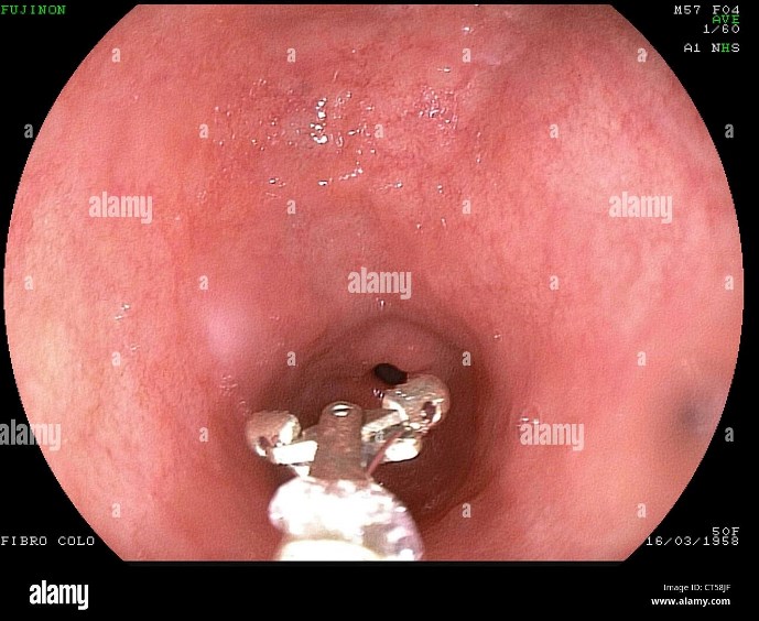 biopsia durante gastroscopia