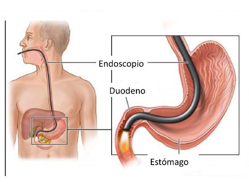 gastroscopia fa male