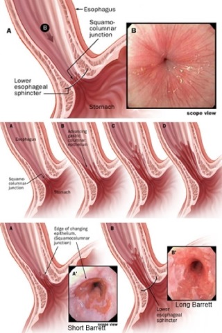 esofago di barrett e reflusso