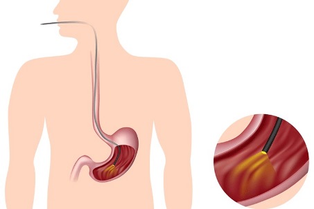 diarrea dopo gastroscopia